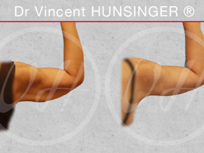 lifting bras chirurgie post bariatrique paris dr vincent hunsinger