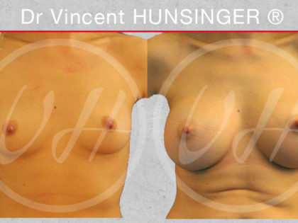 chirurgie des seins paris prothèse mammaire ronde docteur Vincent Hunsinger