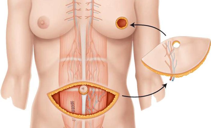 reconstruction mammaire post mastectomie paris : la microchirurgie peut servir aux lambeaux diep pap tram grand dorsal