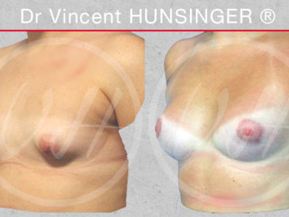 augmentation mammaire seins tubéreux 245cc prothèses anatomiques resultat avant après chirurgie esthétique paris