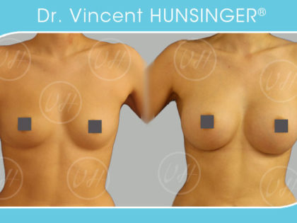 augmentation mammaire prothèses 330cc avant après chirurgien esthétique paris dr Vincent hunsinger