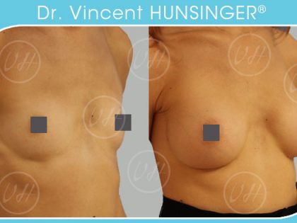 augmentation mammaire prothese 345cc resultat avant apres dr hunsinger chirurgien esthetique paris