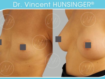 augmentation mammaire protheses retropectorales 345cc resultat avant apres dr hunsinger chirurgien esthetique paris