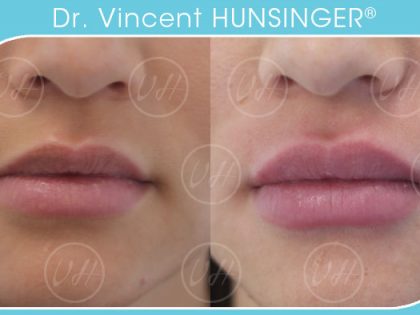 injection acide hyaluronique augmentation lèvres paris dr hunsinger